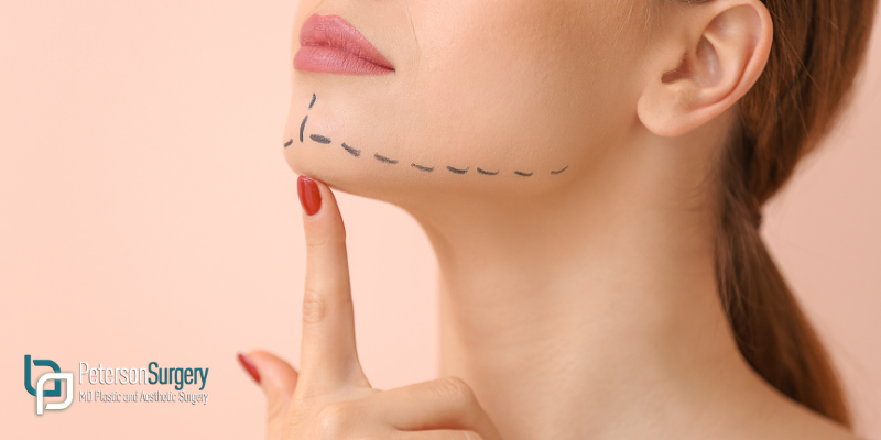 Enhance Your Profile with Chin Surgery in Kelowna
